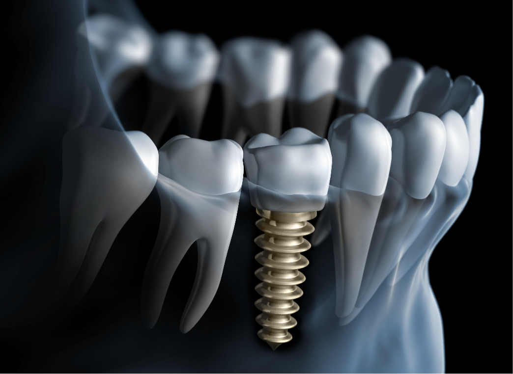 Single Dental Implants