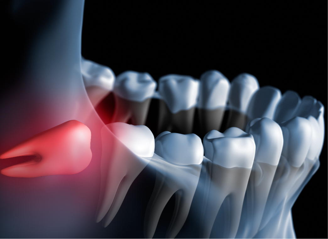 Occlusion Treatments