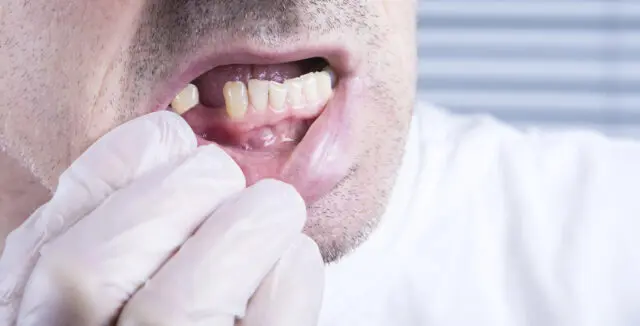 What a Patient Needs to Do When Looking to Restore a Missing Tooth