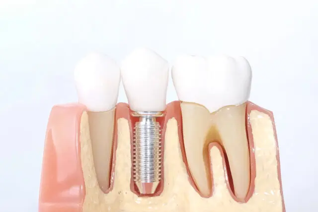 The Steps Involved in Getting and Restoring a Dental Implant